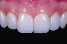 セラミック　歯　審美　白い歯